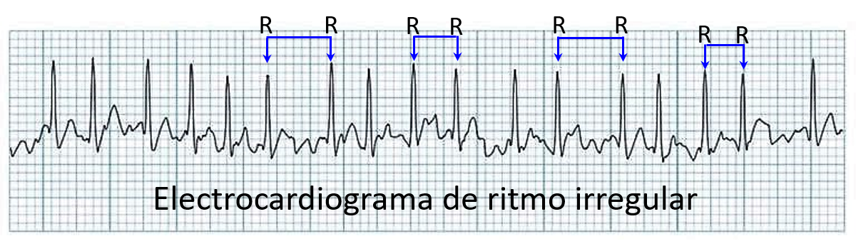 EKG ritmo irregular