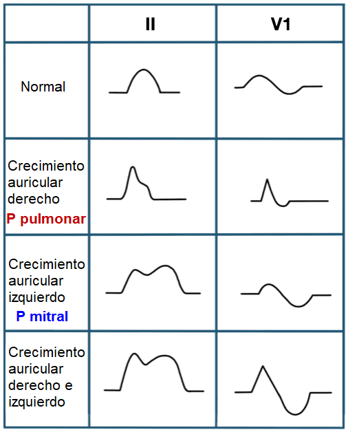 Anomalías auriculares