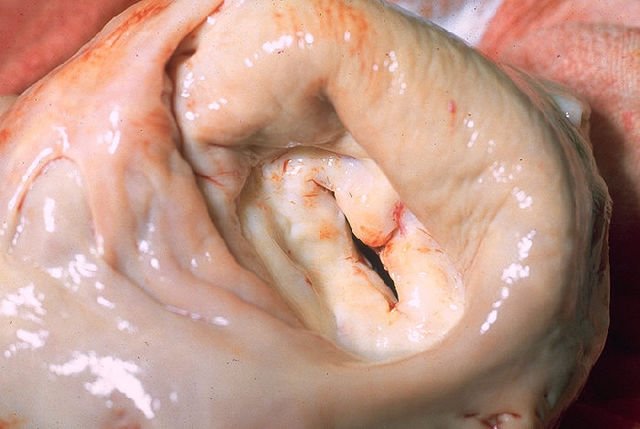 Estenosis mitral con engrosamiento de las valvas. Vista superior